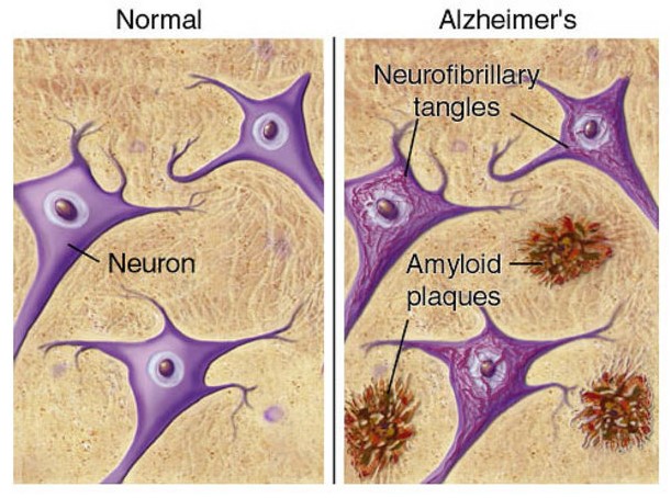 Understanding Plaques and Tangles in Alzheimer’s Disease | Kinesiology